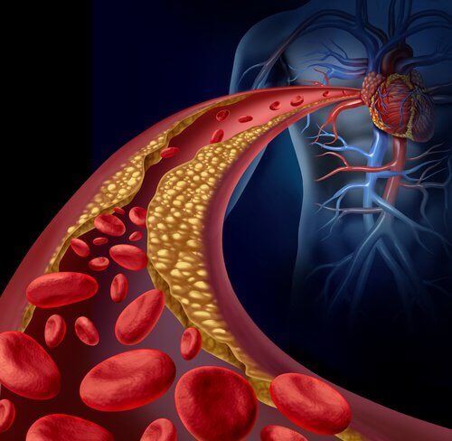 Атеросклерозата е заболяване, което се появява при постоянно високо кръвно налягане.