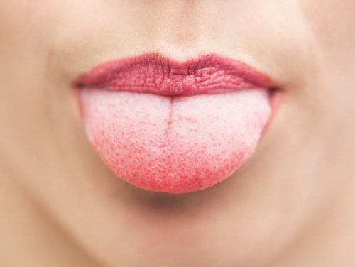 Възпаленото гърло - бял език