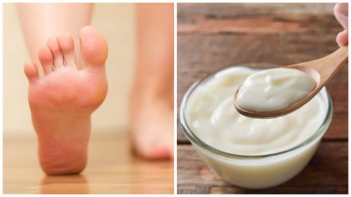 Домашно лечение с кисело мляко и оцет за премахване на мазолите по краката