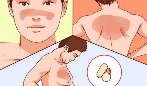 Лупус - какво трябва да знаете за него?