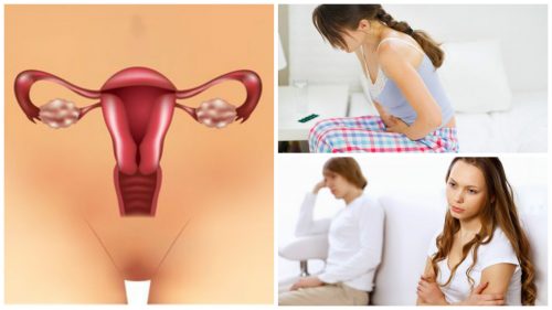 7 неща, които трябва да знаете за синдрома на поликистозните яйчници