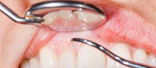 14 причини за кървене на венците при миене на зъбите