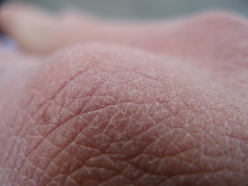 Суха кожа е симптом на дефицит на омега 3 и омега 6 мастни киселини