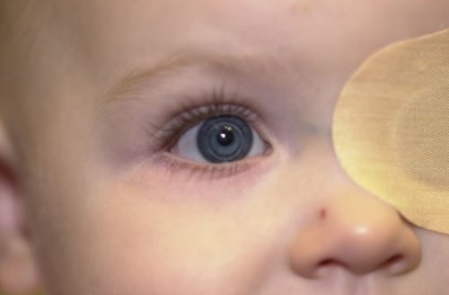 възрастта не е фактор за развитие на катарактата