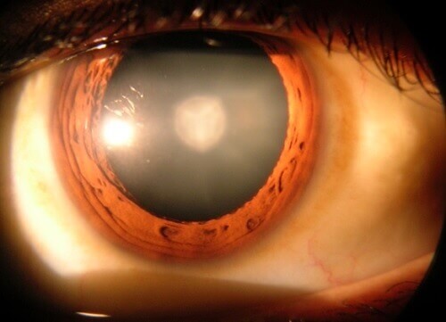 8 неща, които трябва да знаете за катарактата