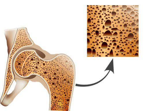 Победете появата на остеопороза с тези натурални средства