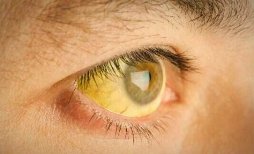 черният дроб дава сигнал за претоварване с оцветяване на кожата в жълто