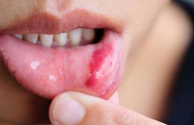 Рак на устата: симптоми, рискови фактори и превенция