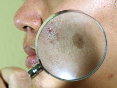 7 натурални процедури против пигментните петна на лицето