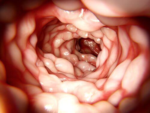 Какво трябва да знаете за лечението на болестта на Крон