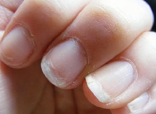 чупливи нокти в следствие на нарушеното кръвообръщение