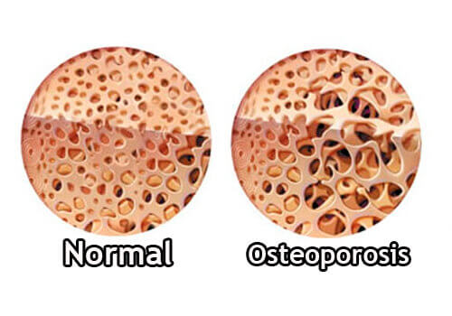 Болестта на Крон води и до усложнения като остеопороза.