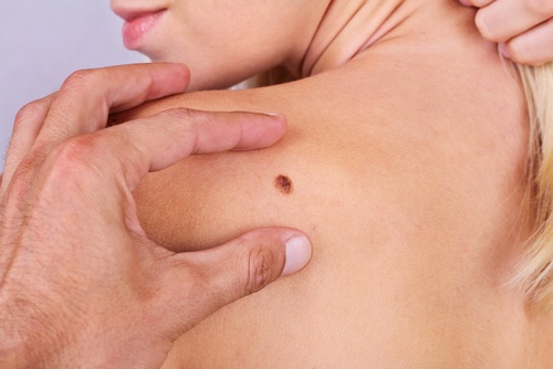 6 симптома на рак на кожата - не ги подценявайте!