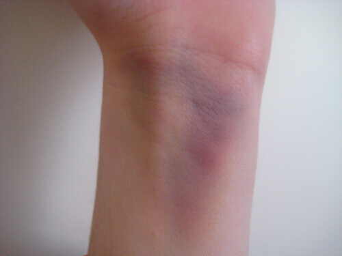 Какво точно е екхимоза?