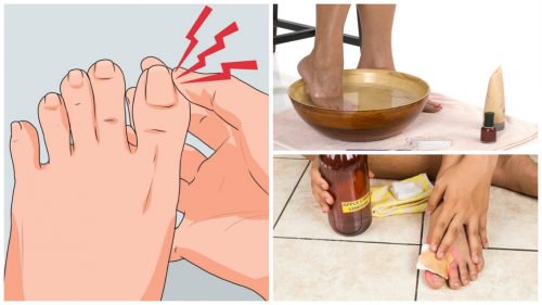 Преборете врастналите нокти на краката с тези 6 вътрешни обжалване