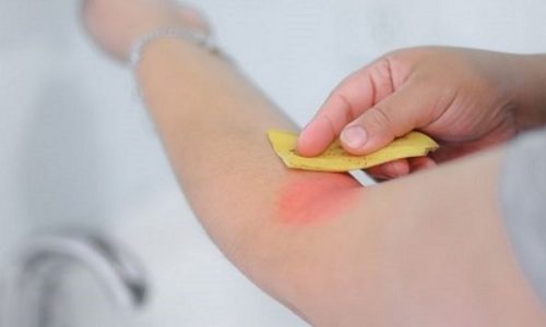Една от ползите на банановите кори е това, че облекчават ухапванията от насекоми.