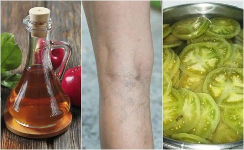 Лечение на варикозни вени с екстракт от оцет и зелен домат