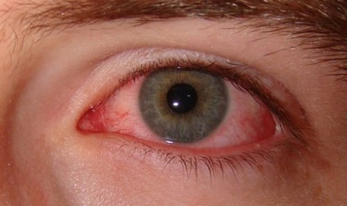 Как се проявява синдрома на сухото око?