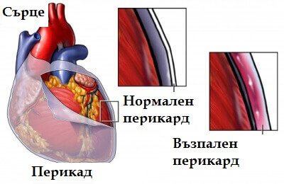Перикардитът причинява болка в гърдите
