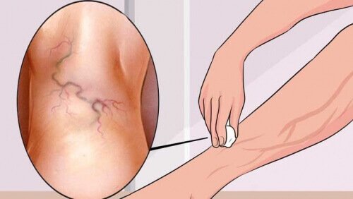 8 упражнения за справяне с разширените вени