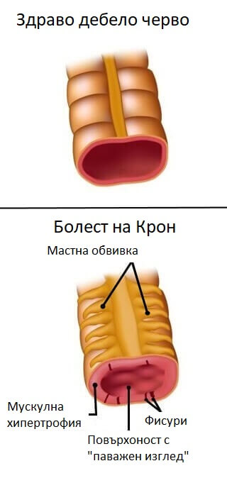 Кои са факторите за болестта на Крон?