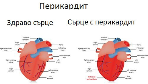 Системният лупус еритематозус: характеристики