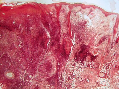 Системният лупус еритематозус - патогени