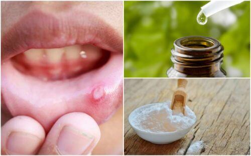 Излекувайте язвите в устата с тези 6 натурални средства