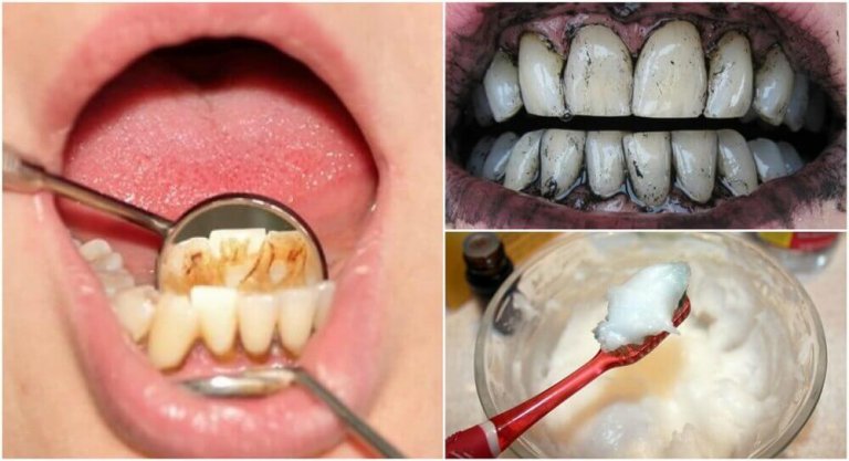 3 ефикасни домашни средства за почистване на зъбния камък