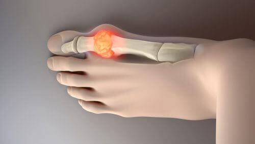 Опитайте тези 8 идеални храни за намаляване на пикочната киселина