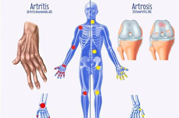 Разликите между артрит, остеоартрит и остеопороза