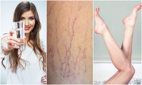 Прочетете тези 6 съвета, ако искате да предотвратите варикозните вени