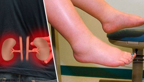 Симптоми на задържането на течности - отичане на краката