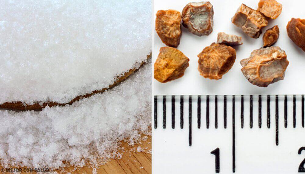 7 домашни средства против камъни в бъбреците