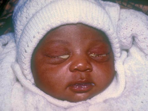 гонореята при децата