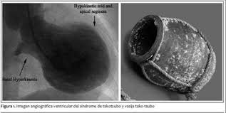 При синдром на разбитото сърце то се деформира