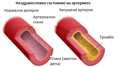 атеросклероза е от най-честите заболявания сред дамите