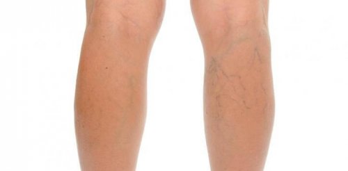 симптомите на флебита могат да бъдат контролирани с натурални средства