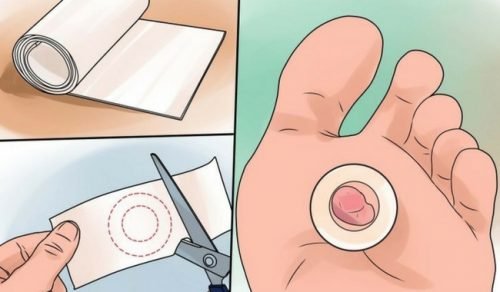 научете как да лекувате пришките