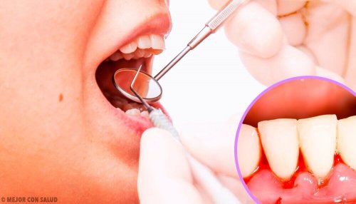 инфекциите на венците водят до появата на гингивит и пародонтит