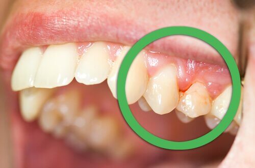 Натурални средства срещу кървенето на венците и разклатените зъби