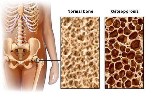 Диета за предотвратяване появата на остеопороза