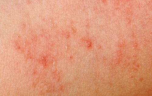 зачервяването на кожата може да е признак на редица здравословни проблеми