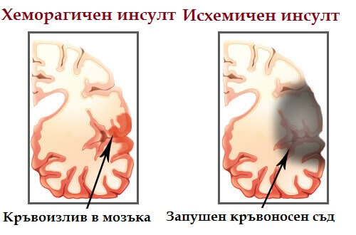 инсултът