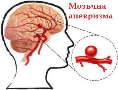 Как да се предпазим от мозъчна аневризма