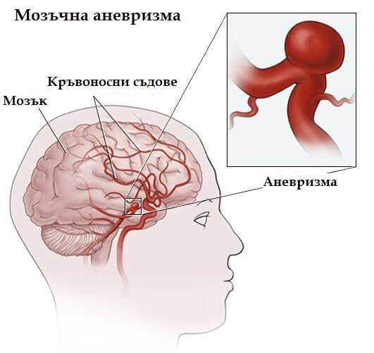 мозъчна аневризма - причини и лечение