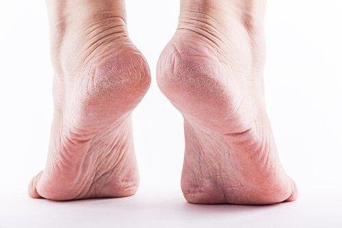 симптоми на мазоли по краката