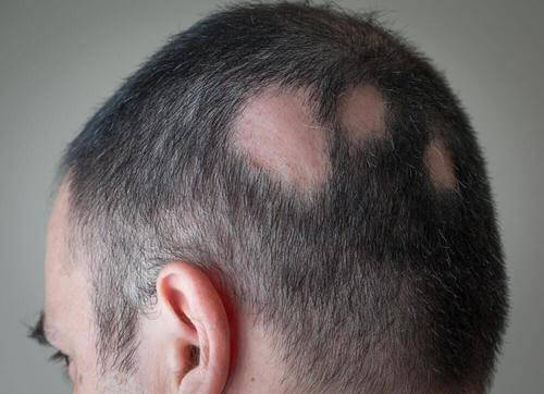 Как да се справите с алопецията с натурални средства