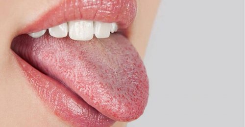 сухота в устата - симптом за захарен диабет