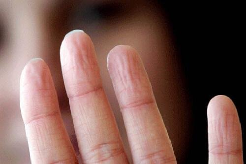 Здравословни проблеми:пръсти на ръка